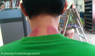 Clumsy Boy's neck. So red and bruised!! But it's normal :)