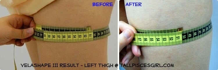 Before & After VelaShape III - Left thigh