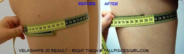Before & After VelaShape III - Right thigh