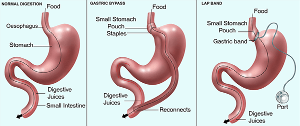 Types of Bariatric Surgery | What You Need to Know About Obesity and Bariatric Surgery Types of Bariatric Surgery