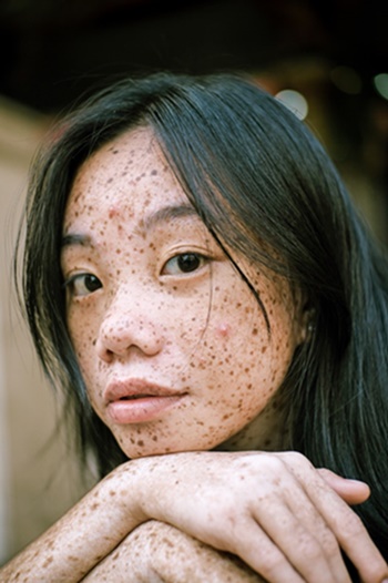 Remove freckles and pigmentation with the help of professionals at an aesthetic clinic | How to Remove Freckles and Pigmentation Remove freckles and pigmentation with the help of professionals at an aesthetic clinic